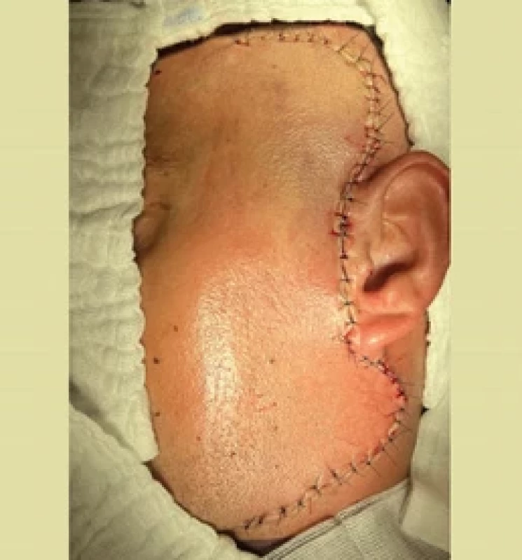 Wound closure – fi rst case.