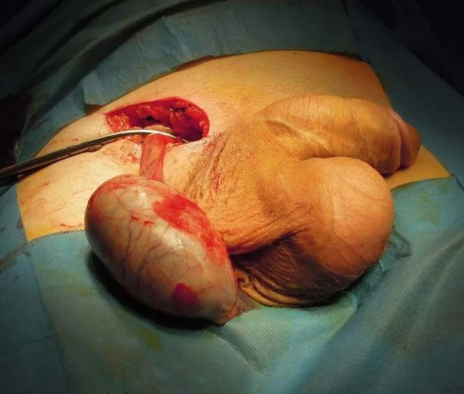 Peroperační nález – revize pravého varlete
Fig. 4. Peroperative photo during right inguinal exploration