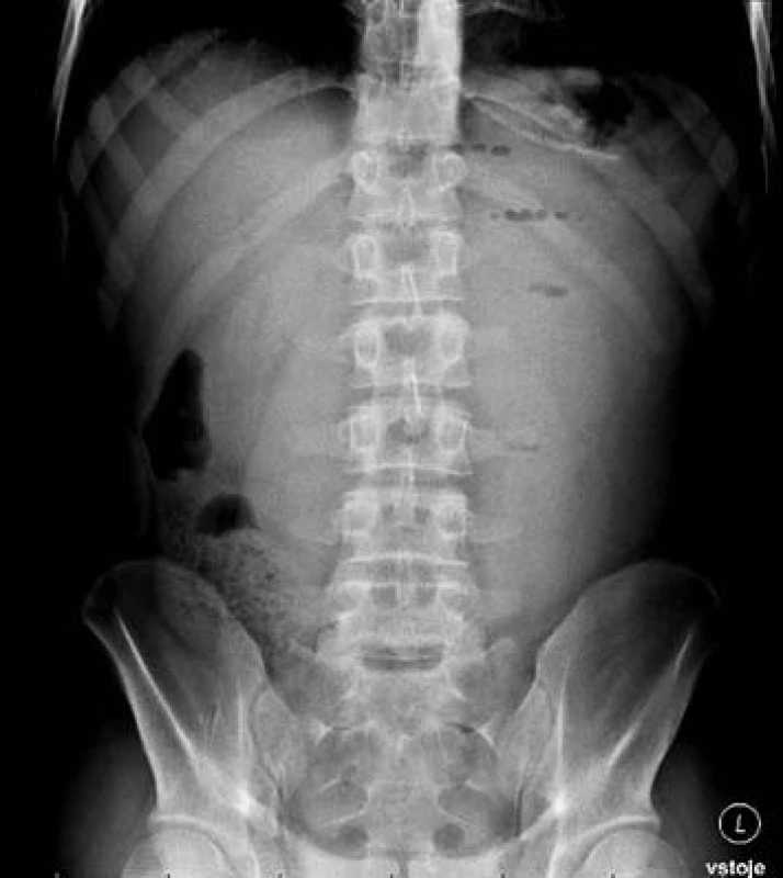 Kontrolní RTG za 8 hod po začátku příhody
Fig. 1: X-ray 8 hours after the beginning of the event