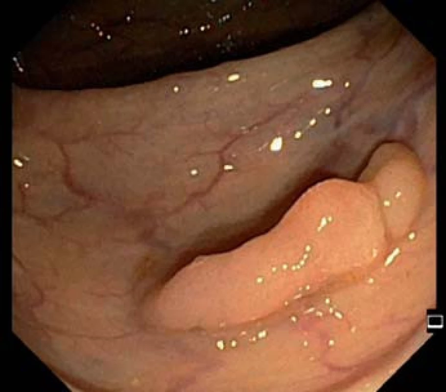 Přisedlý polyp transverza – standardní zobrazení v bílém světle.