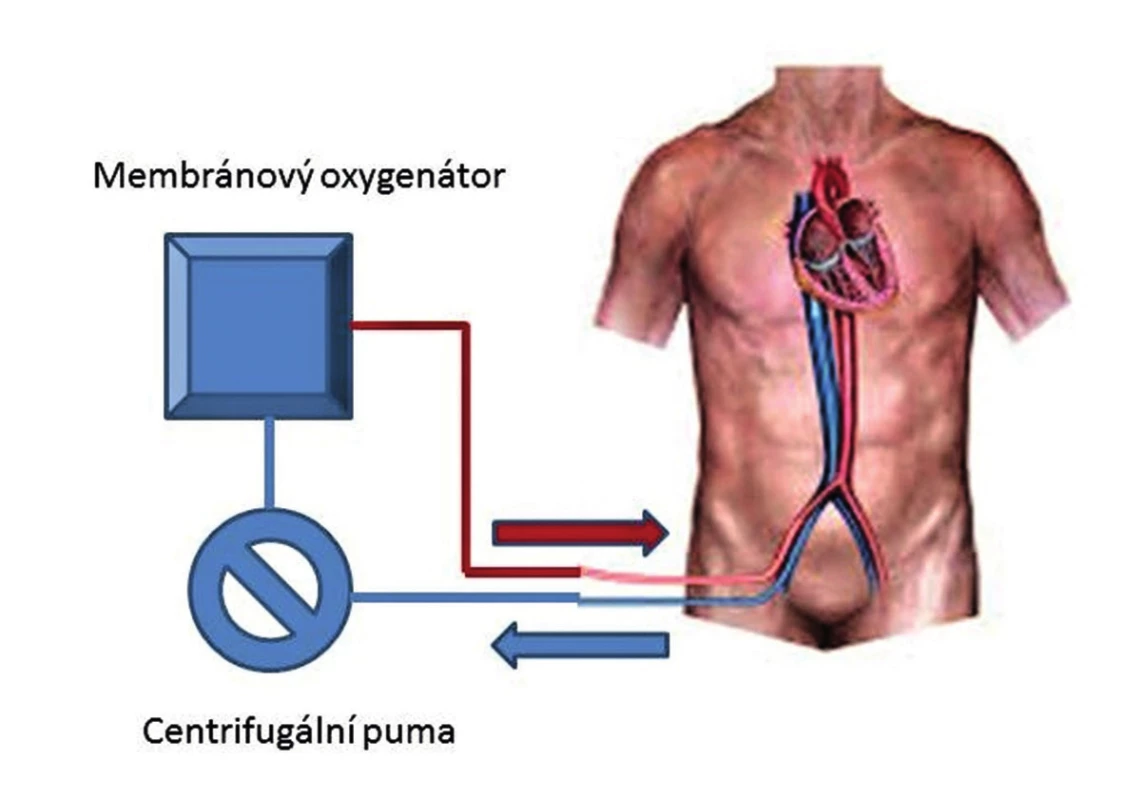 Schéma napojení V-A ECMO
Fig. 3. Diagram of the V-A ECMO circuit