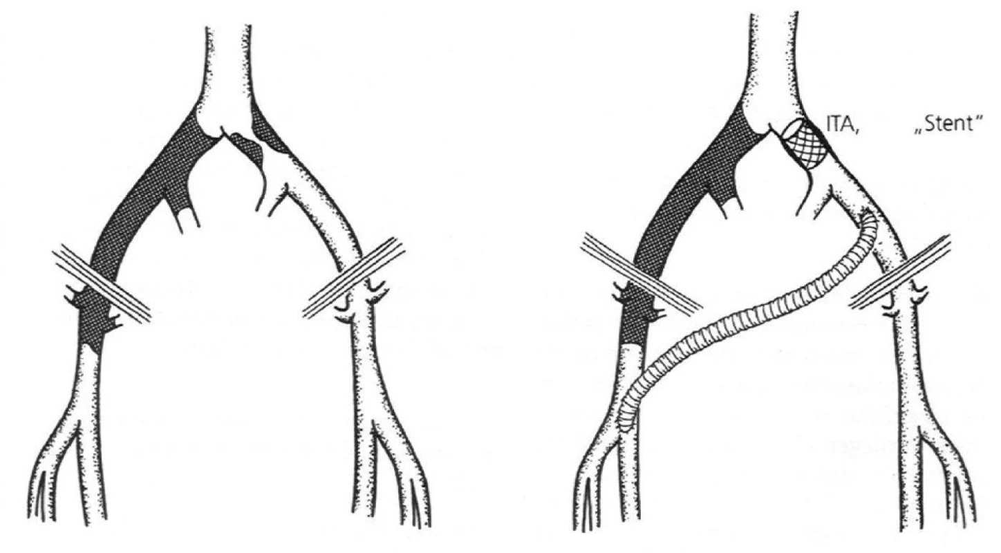 ITA, ITSA hemodynamicky závažnej stenózy AIC, prípadne AIE v spojení s cross-over femoro-femorálnym (ilio-femorálnym) bypassom 
Fig. 1. ITA, ITSA of a hemodynamically serious AIC stenosis, alternatively AIE associated with cross-over femoro-femoral (ilio-femoral) bypass
