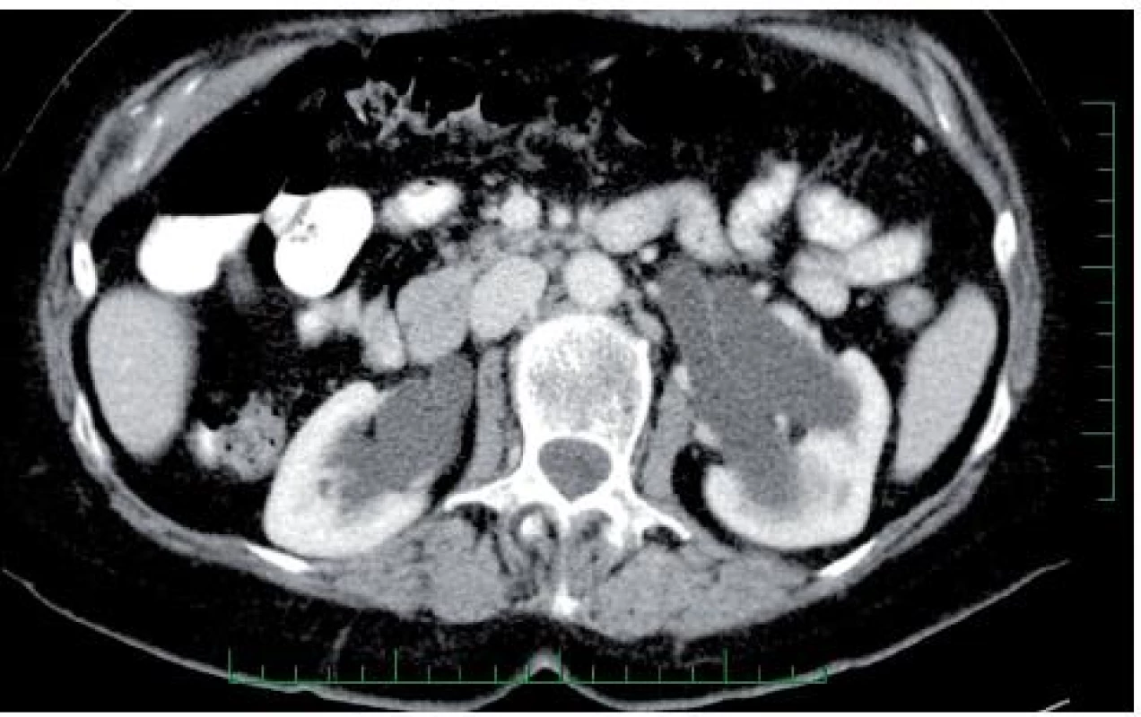 CT vyšetření pacientky před operační revizí – dilatace horního močového traktu (Somatom Emotion 16 (2007), Xenetix 350 (100 ml i.v.)) 
Fig. 1. CT scan of the patient before the surgical revision – a dilatation of the upper urinary tract (Somatom Emotion 16 (2007), Xenetix 350 (100 ml i.v.))