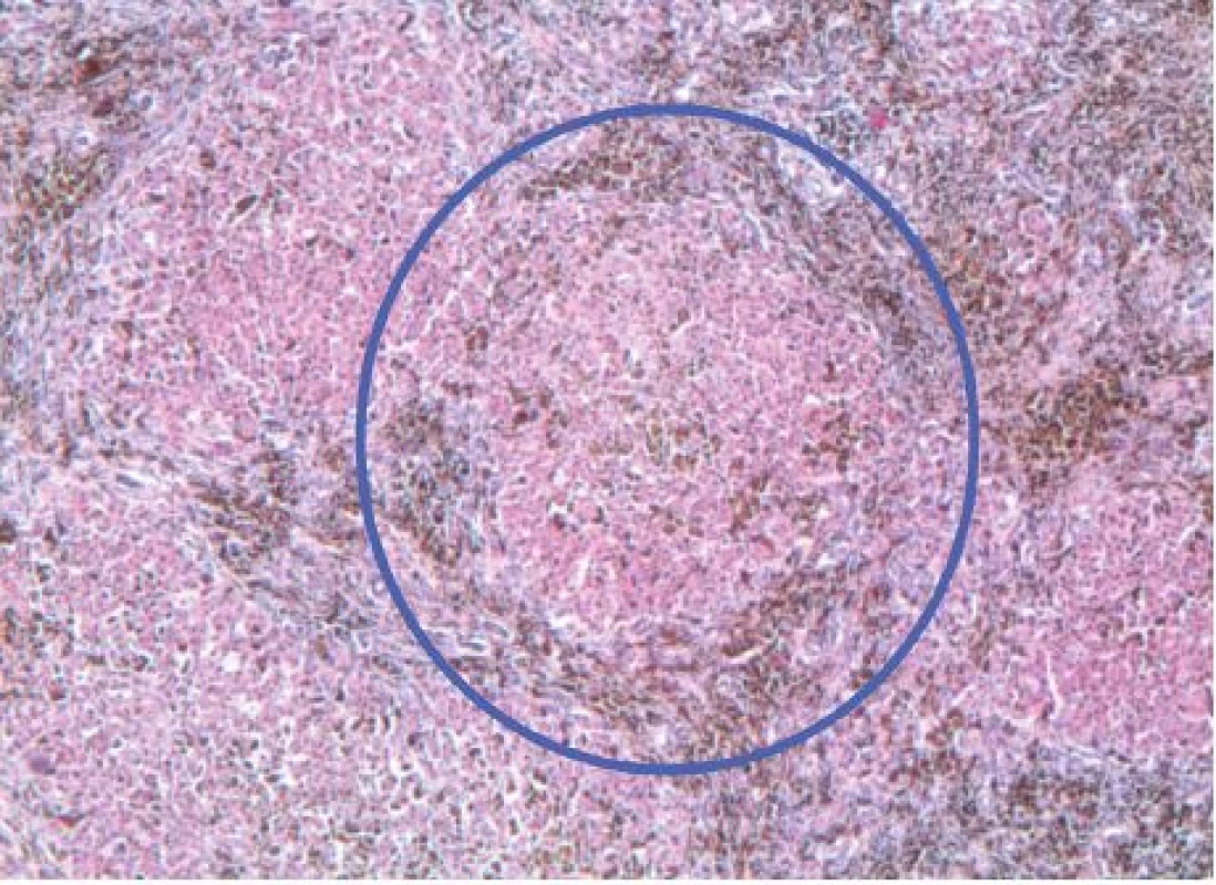 Cirhotický nodulus s hnědými depozity hemosiderinu, hematoxylin-eosin