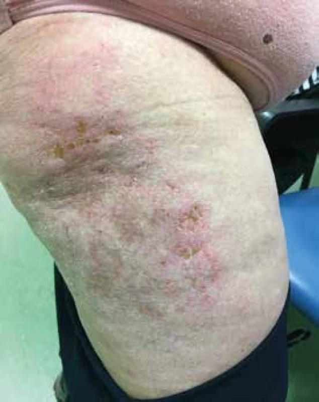 Vyrážka na zevní straně stehna, zde s náznakem ulcerací