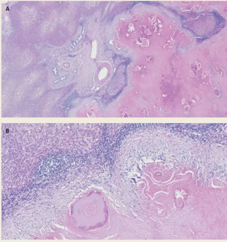 Histological section – A. necrosis with acellular membrane material on the right. Hepatic parenchyma with centrolobular steatosis on the left. Haematoxylin-
eosin staining 10×; B. necrosis with acellular membrane material at the
bottom of the image. The necrotic tissue is bounded by a giant cellular resorptive
reparative reaction with fibrosis and chronic inflammatory infitrate involving eosinophilic
granulocytes at the upper margin. Haematoxylin-eosin staining 50×.<br>
Obr. 4. A. Nekróza s materiálem acelulárních membrán napravo. Parenchym jater
s centrolobulární steatózou nalevo. Barvení hematoxylin-eozinem 10×; B. nekróza
s materiálem acelulárních membrán ve spodní části obrázku. Nekróza je při horním
okraji ohraničena obrovskobuněčnou resorptivně reparativní reakcí s fibrózou
a chronickým zánětlivým infiltrátem s účastí eozinofilních granulocytů. Barvení hematoxylin-
eozinem 50×.