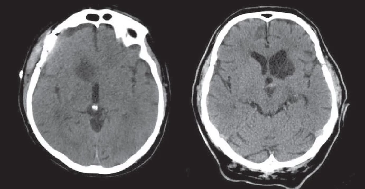 CT snímky zobrazující ischemie v povodí a. reccurens Heubneri (anteroinferiorní striatum [A], caput ncl. caudati, anteromediální putamen a přední raménko vnitřní capsuly [B]).