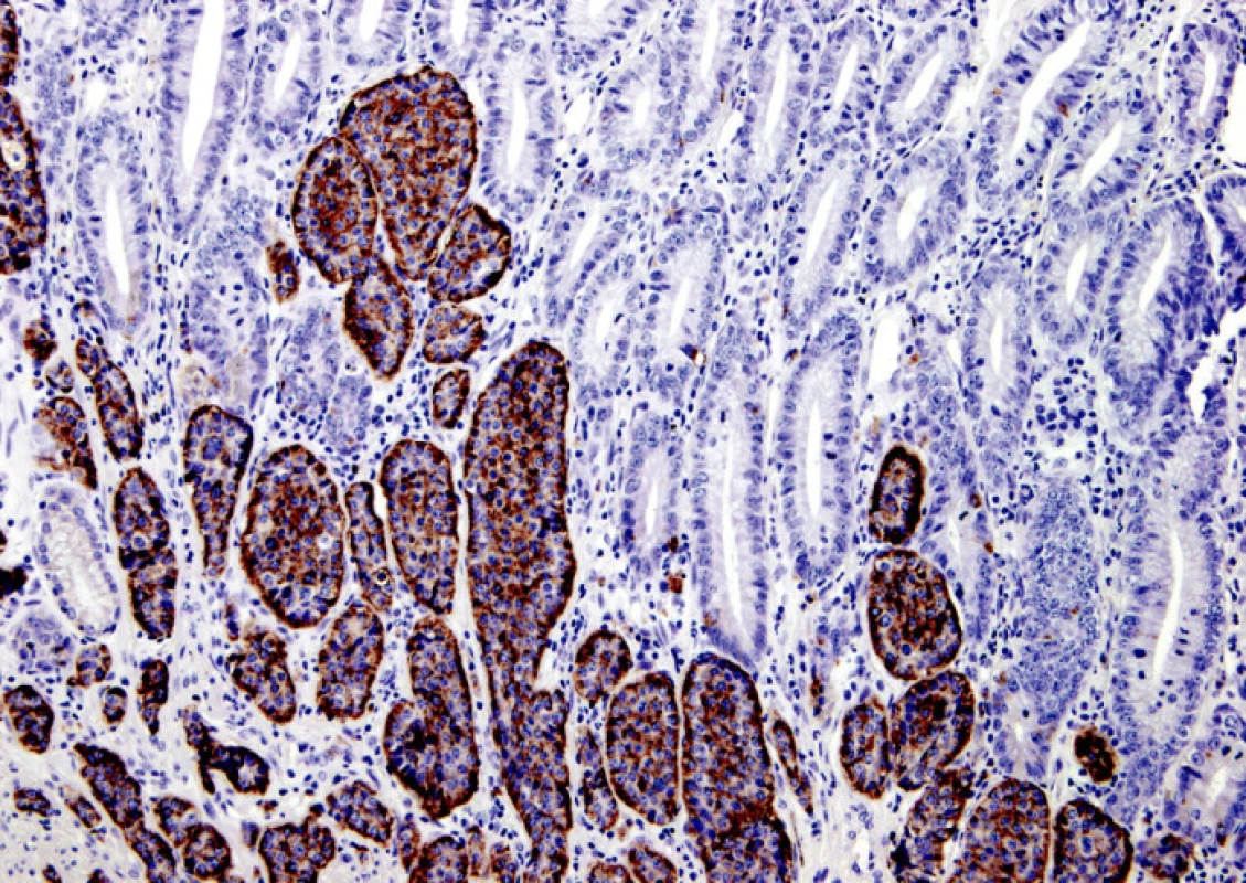 Pozitivita nádorových buněk karcinoidu tenkého střeva (hnědá barva) při imunohistochemické reakci s chromograninem A
Fig. 3. Small intestinal carcinoid cells positivity (brown colour) during immunohistochemical reaction with chromogranine A 
Obrazovou dokumentací a popisy přispěl MUDr. P. Mukenšnábl. Šiklův patologicko-anatomický ústav LF UK, Plzeň