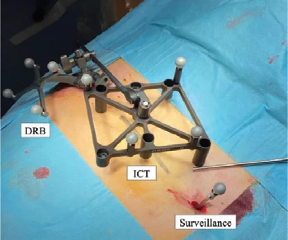 Navigation components of robotic surgery the DRB, the ICT and the Surveillance.