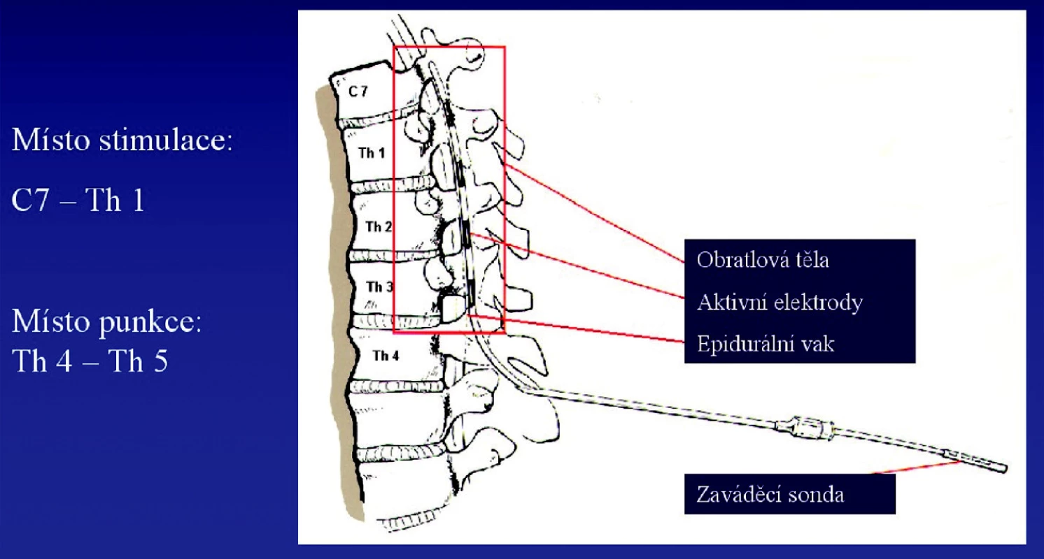 Schéma implantace neurostimulátoru
