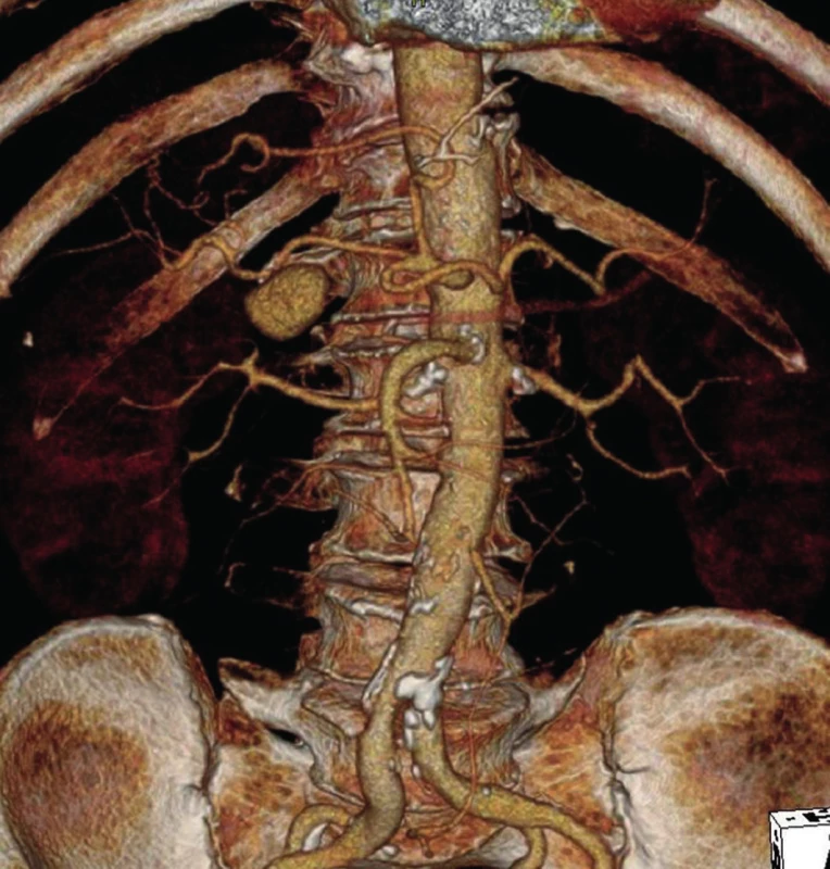 Pseudoaneuryzma a. hepatica v místě odstupu a. gastroduodenalis (3D CT-AG)
Fig. 1: Pseudoaneurysm of hepatic artery at the place where gastroduodenal artery arises (3D-CT AG)