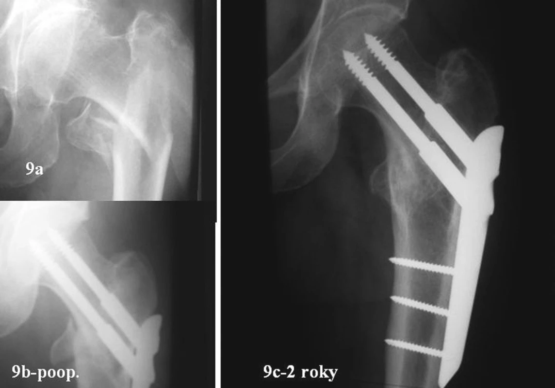 54letá žena. Zlomenina 31A3.3. Úrazový snímek, RTG po operaci a po prohojení za dva roky
Fig. 9a-b. 54- year old female. Type 31A3.3 fracture. Posttraumatic, postsurgical views and a post-healing view after 2 years