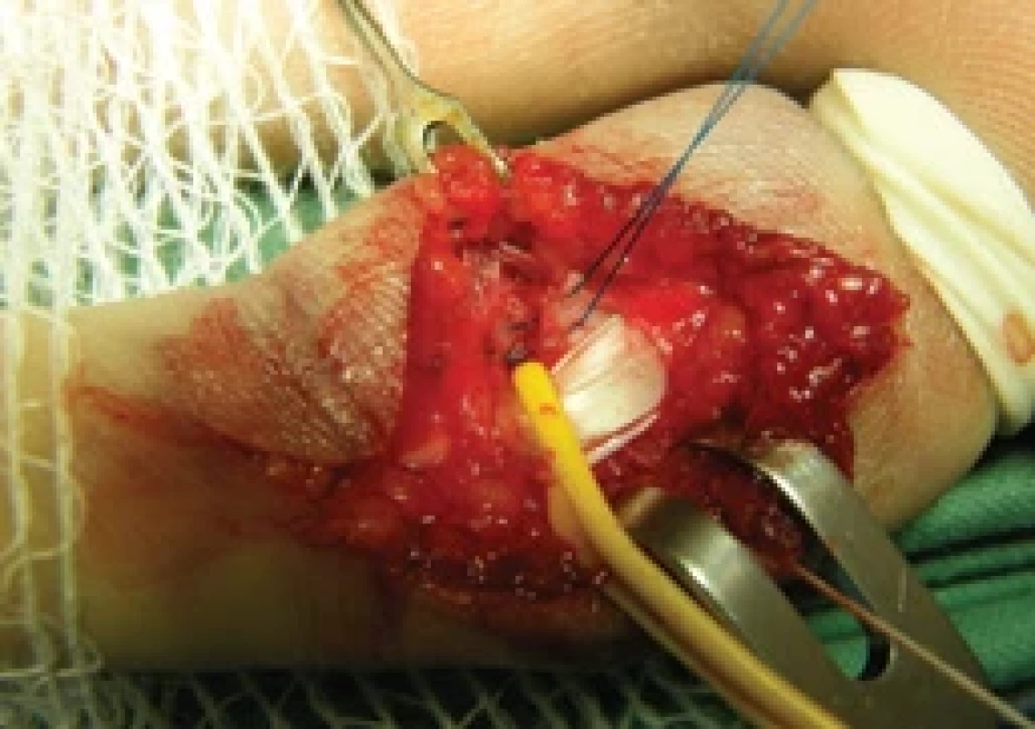 The fragment-to-ligament “around the bone”-like suture.