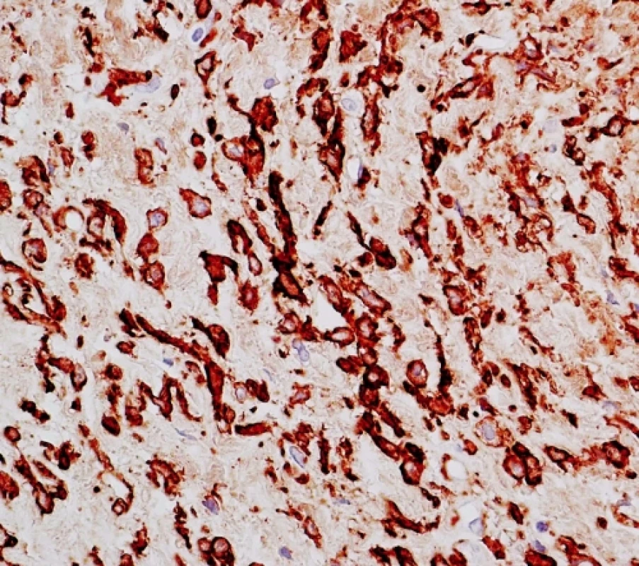Imunohistochemický průkaz hladkosvalového aktinu (zvětšeno 400x