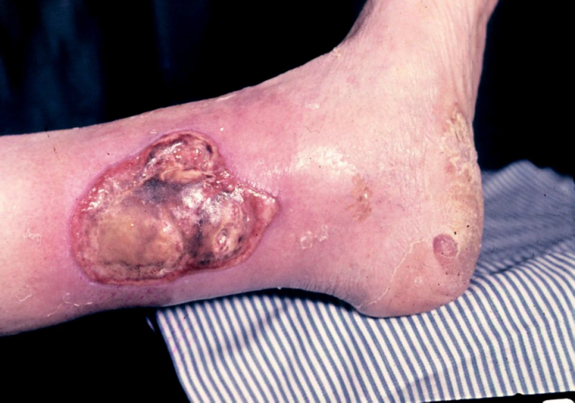 Ulcus cruris arteriosum.