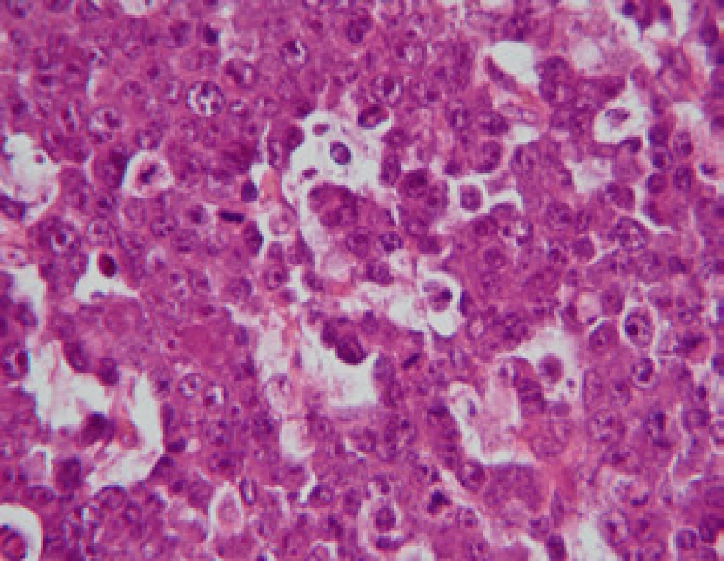 Detail plasmablastického lymfomu – velké atypické lymfoidní elementy (Hematoxylin – eosin, zvětšení 400x, foto Radim Žalud)
Fig. 3. Plasmablastic lymphoma – detail of large atypic lymphoid elements (Photo R. Žalud)
