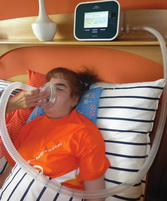 Aplikace Cough Assist pro usnadnění expektorace u nemocné s mukopolysacharidózou v domácím prostředí (se souhlasem zákonného zástupce)