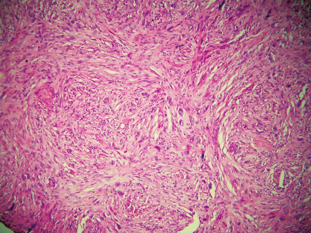 Histologický nález – storiformně uspořádané nádorové buňky, často vřetenitého tvaru