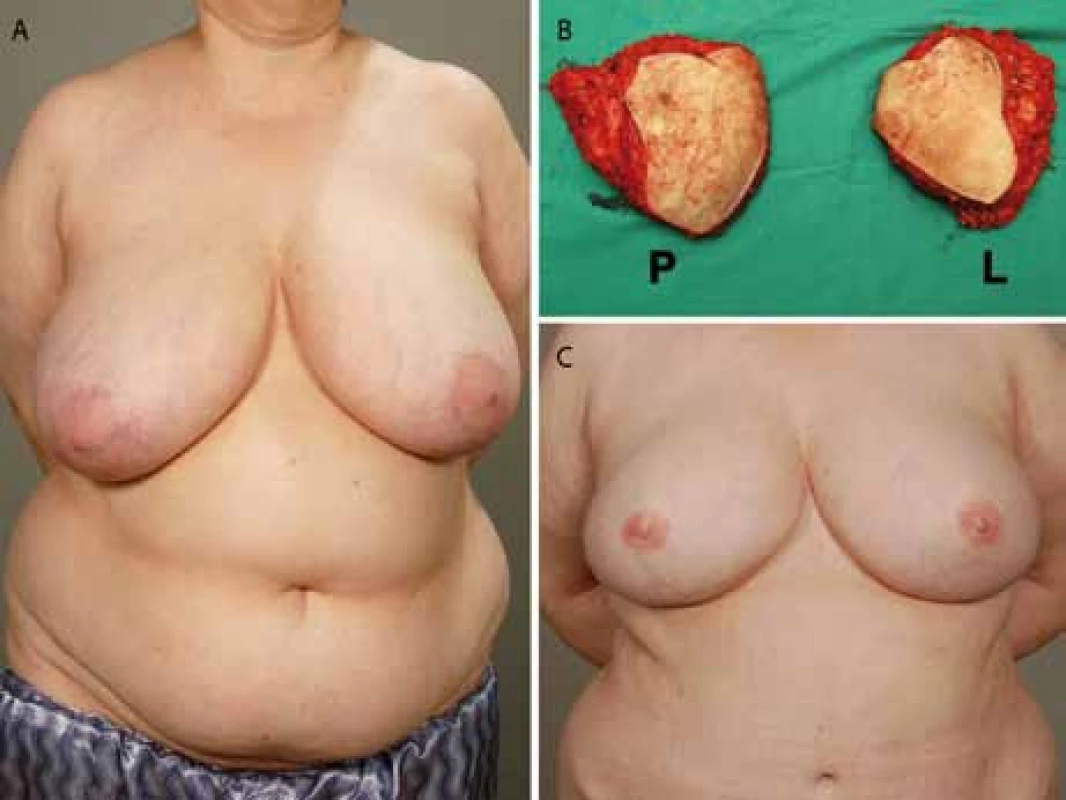 A. Zdravá BRCA1-pozitivní pacientka (skupina A) před prostou, kůži šetřící mastektomií; 1B. Preparáty po mastektomiiů; 1C. Po rekonstrukci dvěma DIEP laloky a rekonstrukci areolo-mamilárních komplexů.