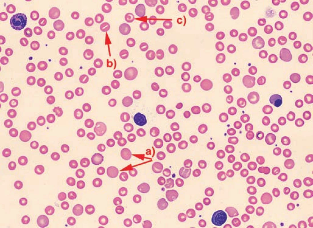 Nátěr periferní krve pacienta č. 3 – anizocytóza, polychromazie (a), ojedinělé stomatocyty (b) a terčovité erytrocyty (c).
Fig. 2. The No. 3 patient’s blood smear – anisocytosis, polychromasia (a), isolated stomatocytes (b) and target erythrocytes (c).