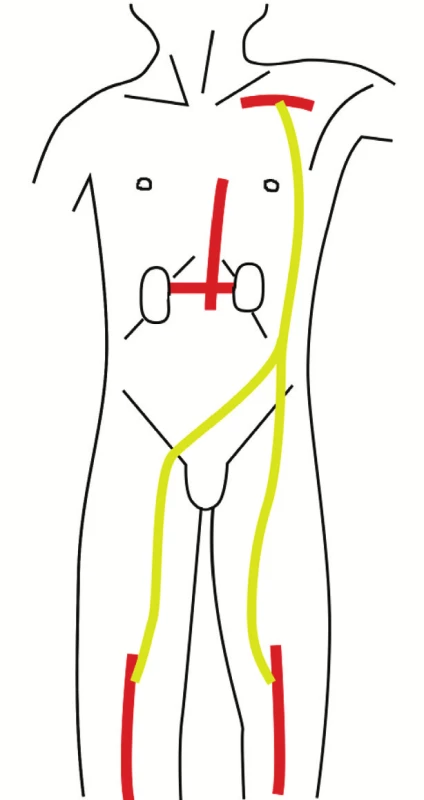 Schéma axillo-bipopliteálního bypassu
Fig. 4. Axillobipopliteal bypass