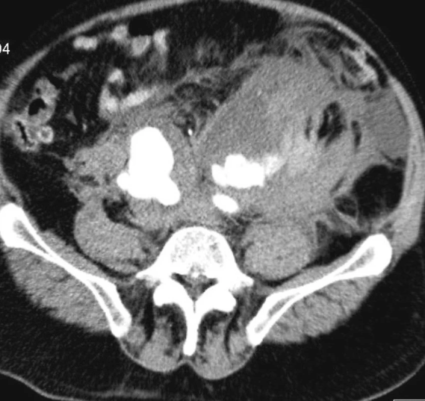 Ruptúrovaná aneuryzma AIC na CT angiografii
Fig. 1. Ruptured aneurysm of common iliac artery on CT – angiography