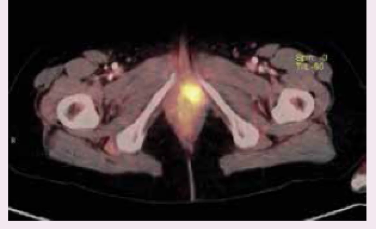 Recidiva melanomu na PET-CT