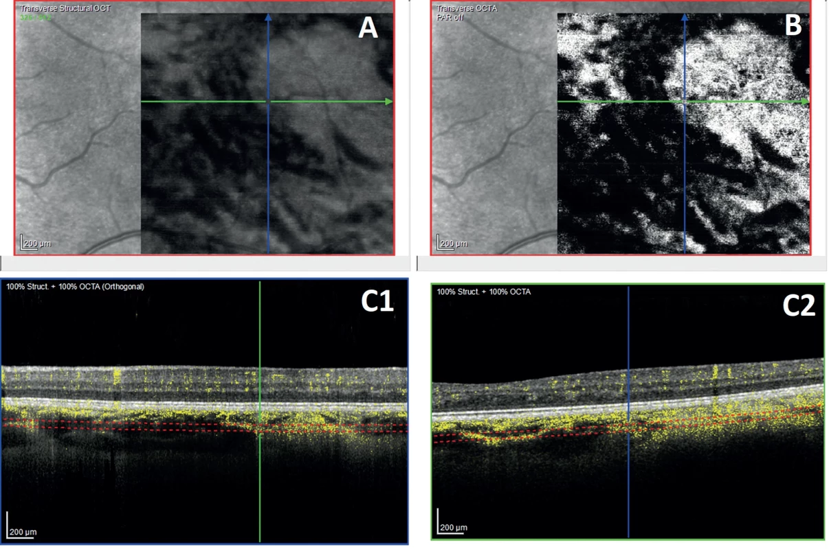 En-face image of the deep choroid derived from structural OCT
