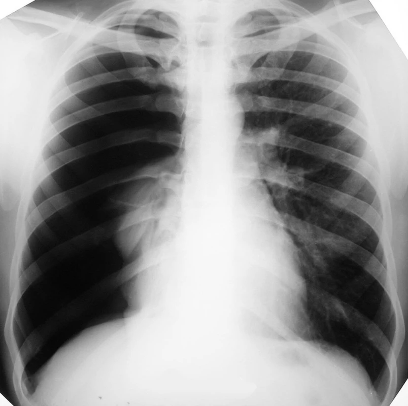 RTG hrudníka pri prijatí, zobrazujúca kompletný spontánny PNO vpravo
Fig. 1. Thoracic X-ray on admission, depicting complete spontaneous pneumothorax on the right
