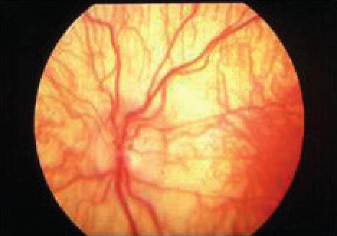 Fundus pri totálnom okulokutánnom albinizme