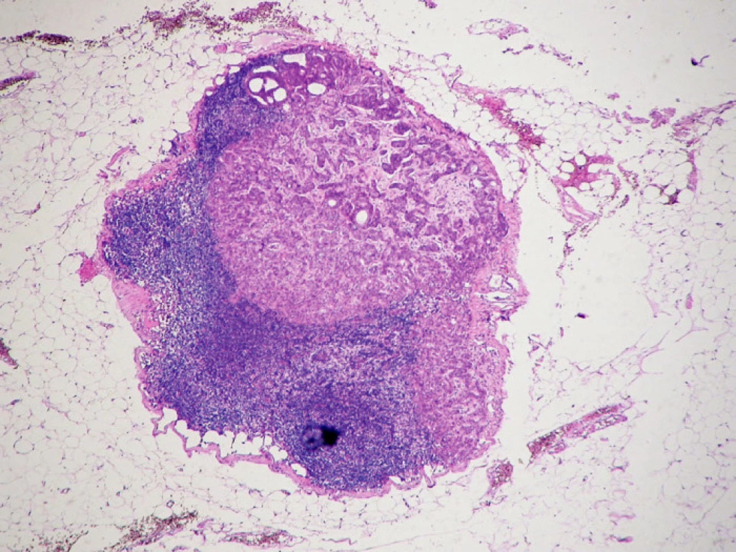 Makrometastáza karcinomu prsu v lymfatické uzlině, obarveno hematoxylinem eosinem
Fig. 1. The breast carcinoma macrometastasis in a lymph node, hematoxylin- eosin staining