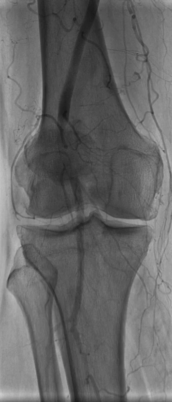 Angiografický nález disekcie s minimálnym tokom v pravom lúmen
Fig. 1. Angiographic finding of dissection, with minimal blood flow in the right lumen