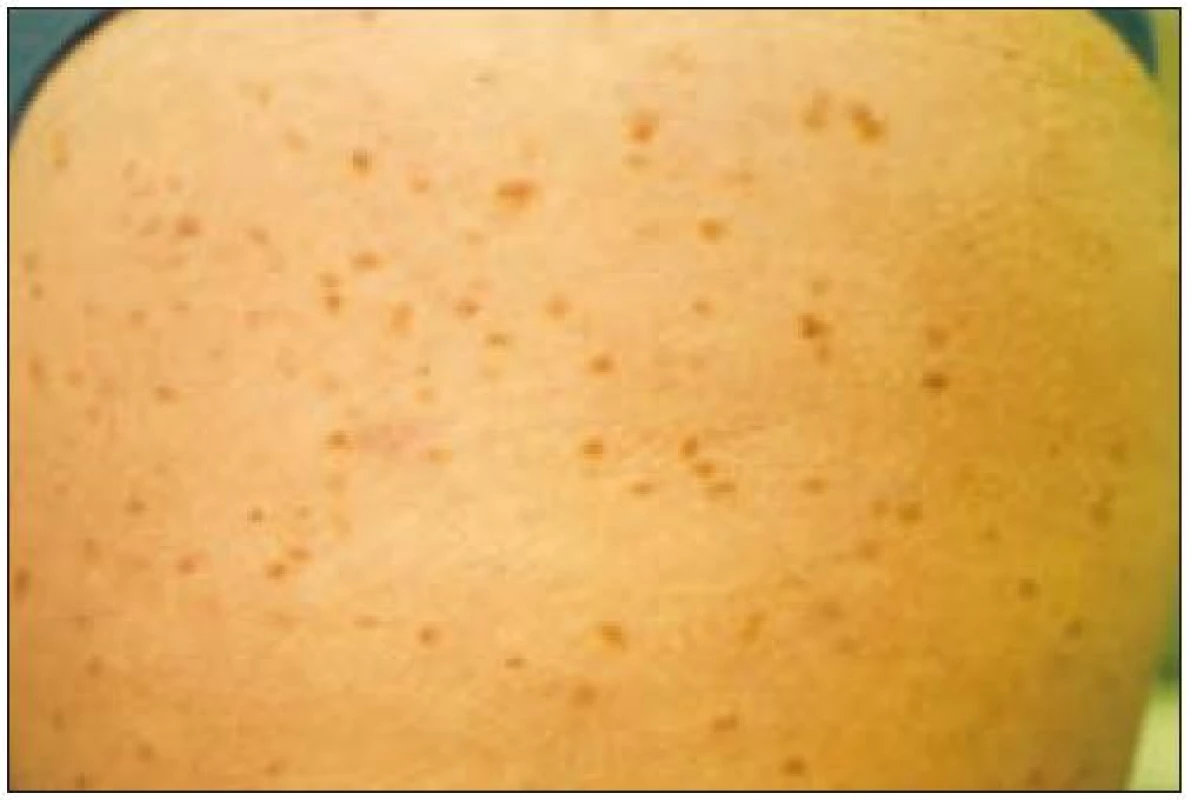 Urticaria pigmentosa u pacientky s indolentní systémovou mastocytózou. Snímek doc. MUDr. Michael Doubek, Ph.D.