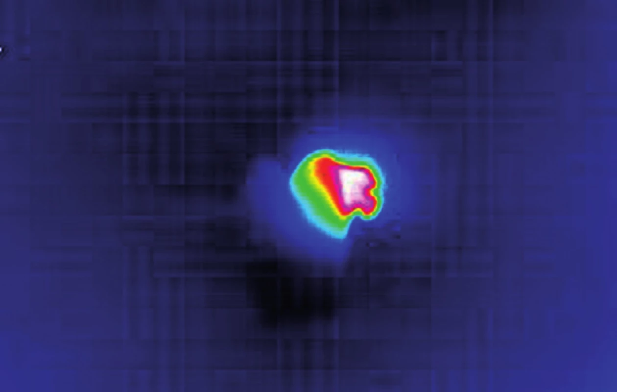 Kamera Optilas – Electrophysics citlivá na infračervené záření v průběhu měření ohřevu u zubu 14.