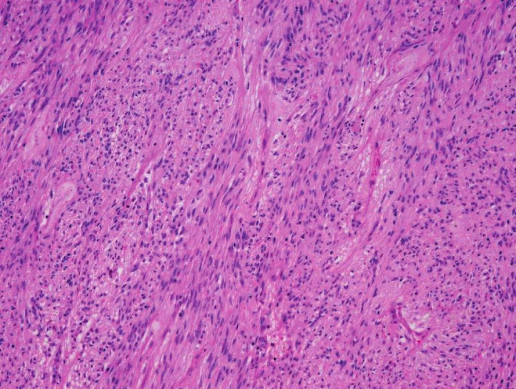 Barvení hematoxylin-eosin tumoru s klidnými jádry a poměrnou uniformitou vřetenitých buněk
Fig. 1: Hematoxylin and eosin staining of the tumor with calm cores and the relative uniformity of spindle cells