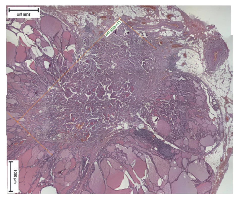 Extrakapsulární prorůstání nádoru<br>
Fig. 3: Extracapsular invasion of tumor cell