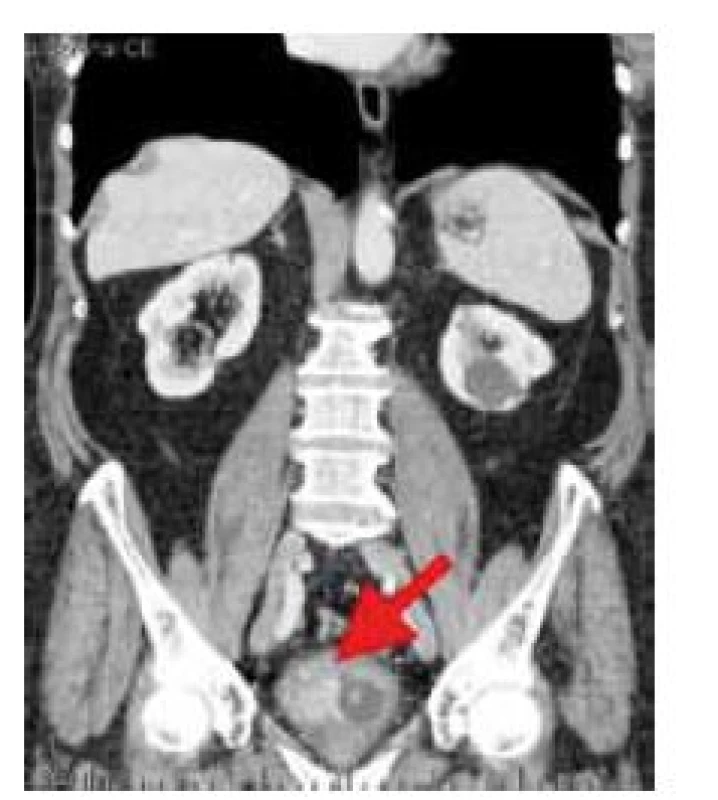 Nádor močového mechúra v obraze počítačovej tomografie (označený šípkou)
Fig. 1. Tumour of the urinary bladder in computer tomography image (arrow)