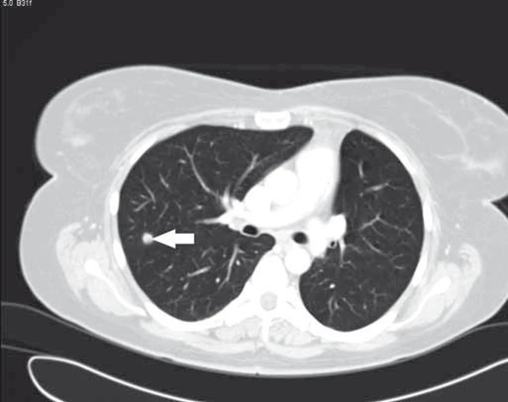 Bílá šipka – metastáza CRC v pravém horním plicním poli.
Fig. 3. White arrow – colorectal cancer metastasis in right upper lung lobe.