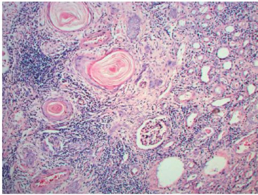 Dlaždicobuněčný karcinom ledvinné pánvičky (100×HE)
Fig. 2. Squamous cell carcinoma of the renal pelvis (100×HE)