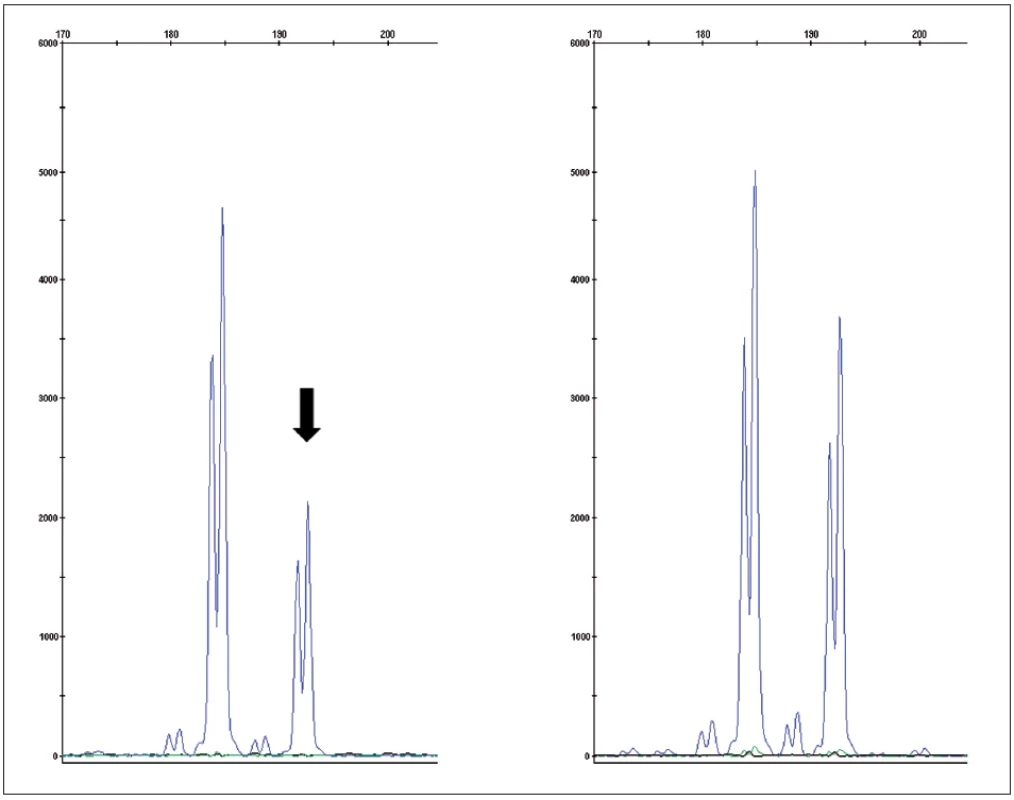 Fragmentační analýza mikrosatelitního markeru D3S1768S potvrzující ztrátu heterozygosity v nádorové tkáni (vlevo) oproti kontrole (zdravá tkáň – vpravo)
Fig. 4. Fragment analysis of microsatelite marker D3S1768S proving loss of heteroyzgosity in tumor tissue (left) compared to control (normal tissue – right)
