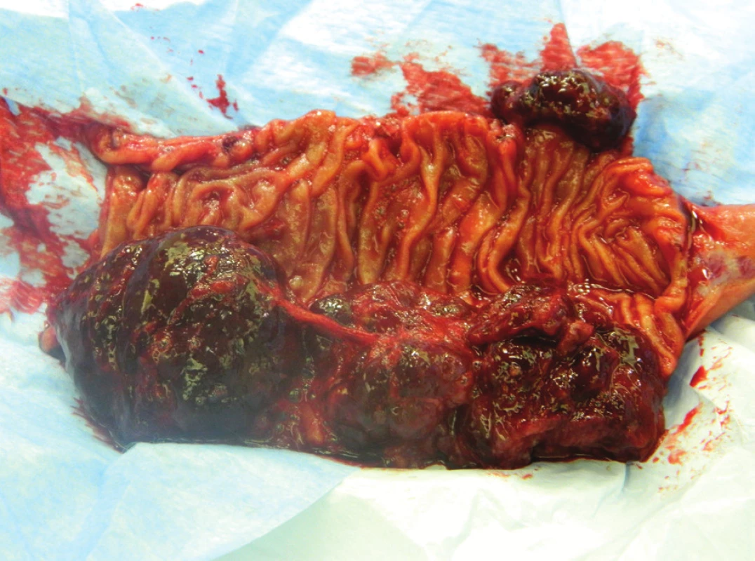 Tři prokrvácené polypoidní angiosarkomy v resekátu duodena
Fig. 3: Three haemorrhagic polypoid angiosarcomas inside resected duodenal specimen