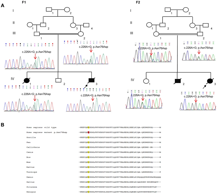 The missense <i>MAGMAS</i> mutation c.226A>G (p.Asn76Asp).