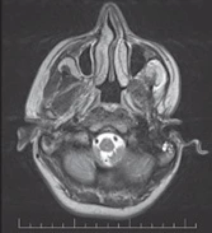 Postoperative MRI – fi rst case.