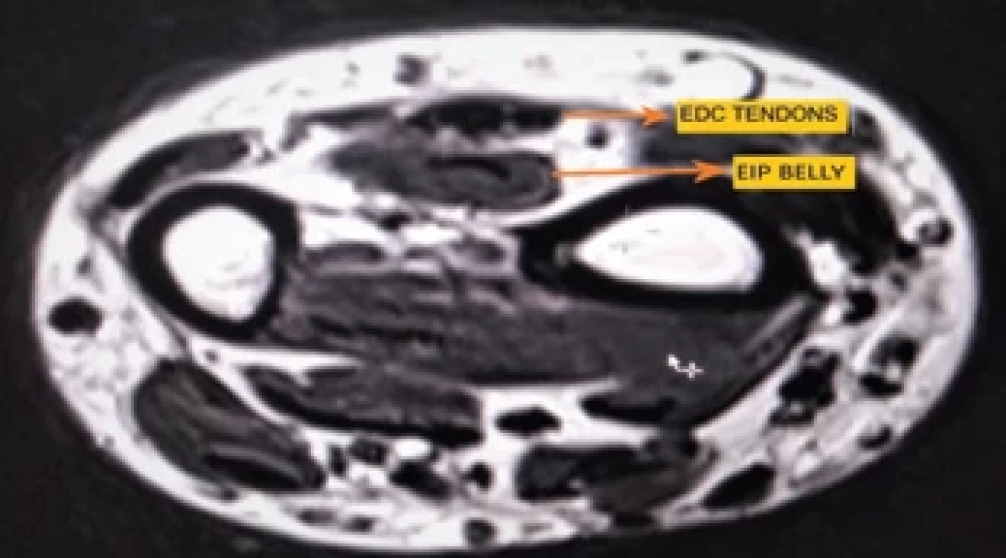 Transverse section at distal end of radius ulna showing belly of extensor indicis proprius (EIP) near the interosseous membrane (it is the only muscle belly to be present at that location, which is present in this MRI and extensor digitorum communis (EDC) tendons.
