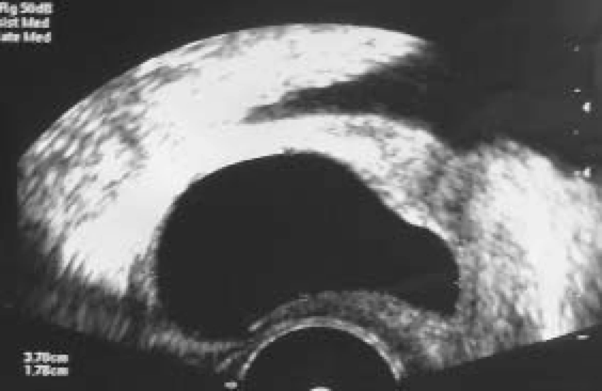 TRUS. Objemná cysta prostaty při TRUS-vyšetření, sagitální řez. Cysta je hladce ohraničena a má anechogenní obsah.
