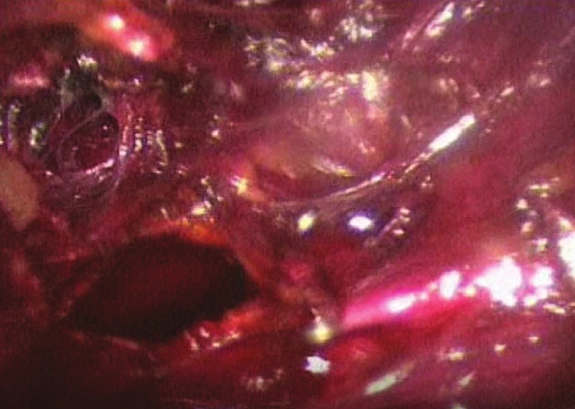 Léze vena cava inferior
Fig. 1: Lesion of the inferior vena cava