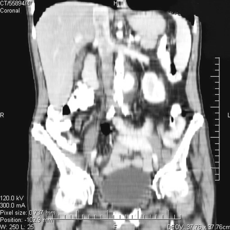 Mykotické aneuryzma abdominální aorty – CT obraz (rekonstrukce)
Fig. 1. Mycotic aneurysm of the abdominal aorta – CT view (reconstruction)