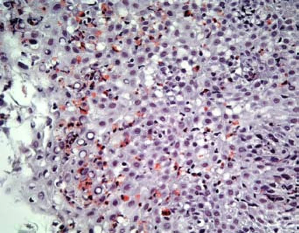 Epitel jícnu v barvení kongo červení (1 HPF).
Fig. 3. Esophageal epithelium – congo red staining (1 HPF).