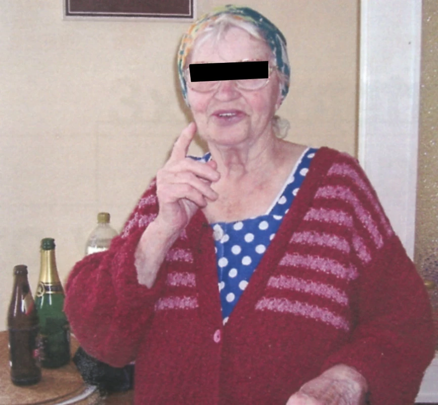 Seniorka 82 let, polymorbidní. Jasně jsou vyjádřeny somatické změny charakteristické pro vysoký věk
Fig. 1. An elderly female, 82 y.o.a, polymorbid. Old age- characteristic somatic changes are clearly expressed