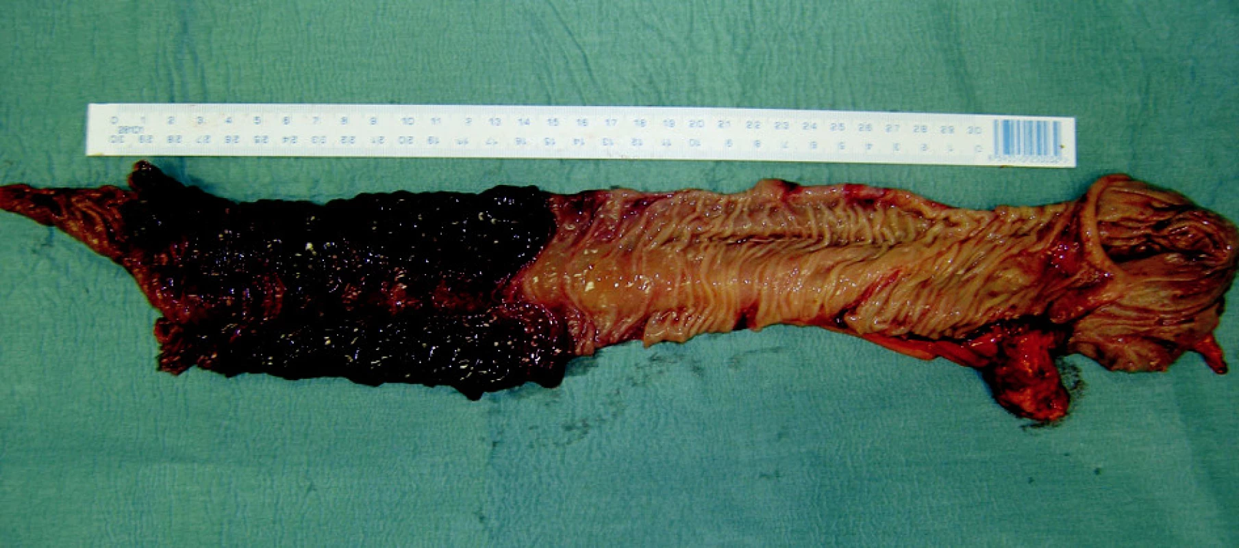 Stopkatý tumor distálního ilea – maligní melanom
Fig. 4. The stem tumor of the distal ileum – melanoma malignum